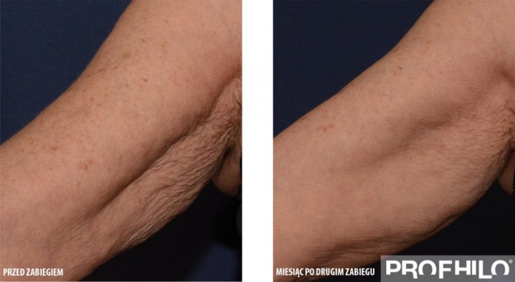 Profhilo Body doda Ci urody